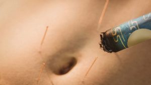 Acupuncture treatment in Worthing