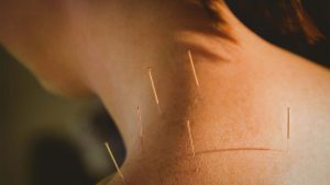 Acupuncture treatment