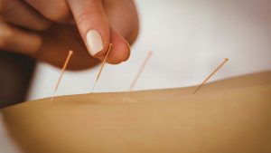 Acupuncture treatment in Worthing