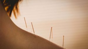 Acupuncture treatment in Worthing