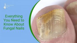 fungal nails Worthing